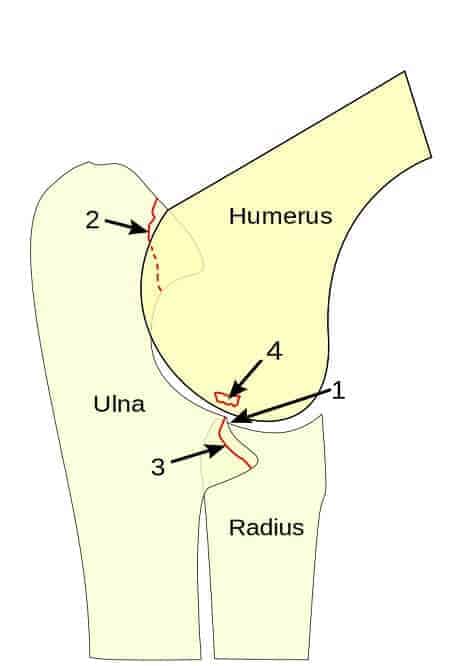 Das Bild zeigt eine ausgeprägte Ellbogendysplasie und Ungleichgewicht zwischen Oberarmknochen, Elle und Speiche.